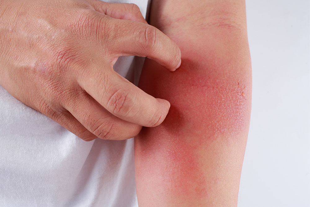 Eczema – Soaps to avoid